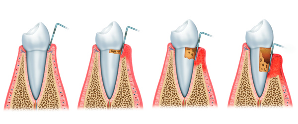 periodontitis