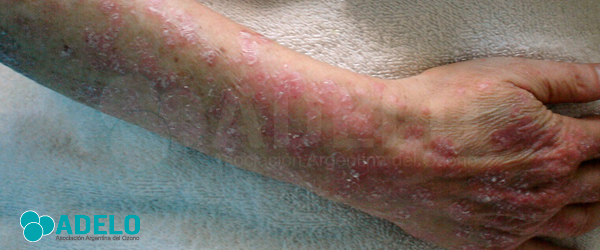 tratamiento para psoriasis