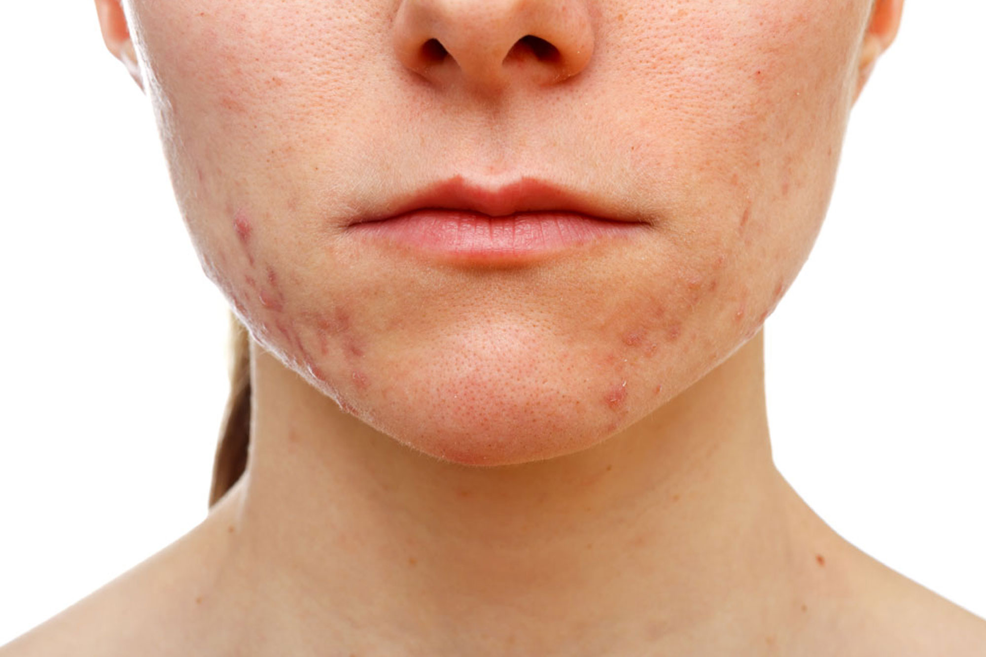 Acne ozono terapia