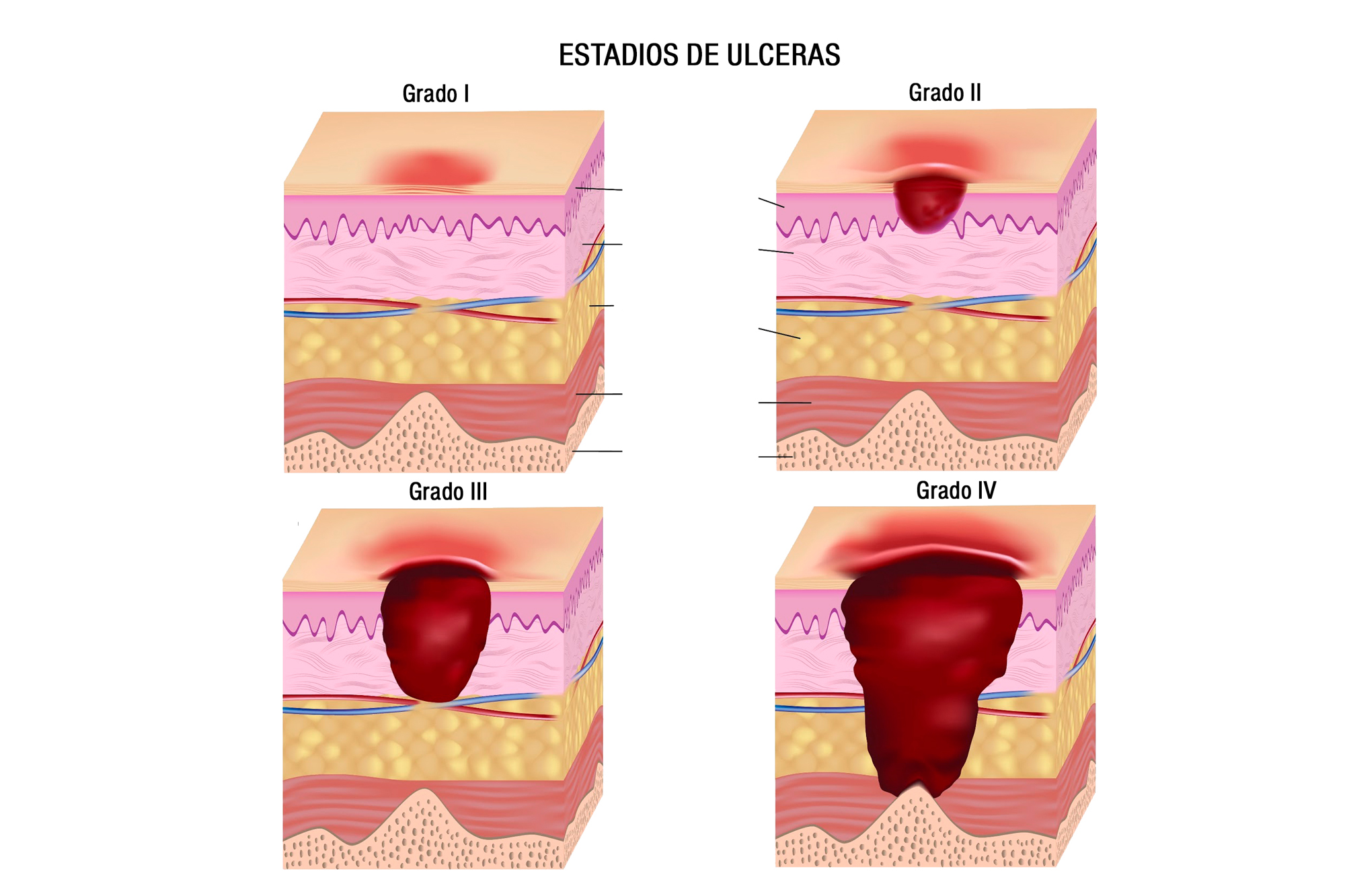 terapia herpes